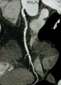 CT scan showing narrowing in RCA