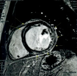 Image of cardiac MRI showing LGE