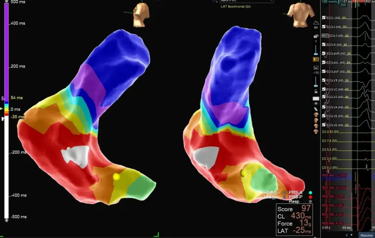 Catheter Ablation