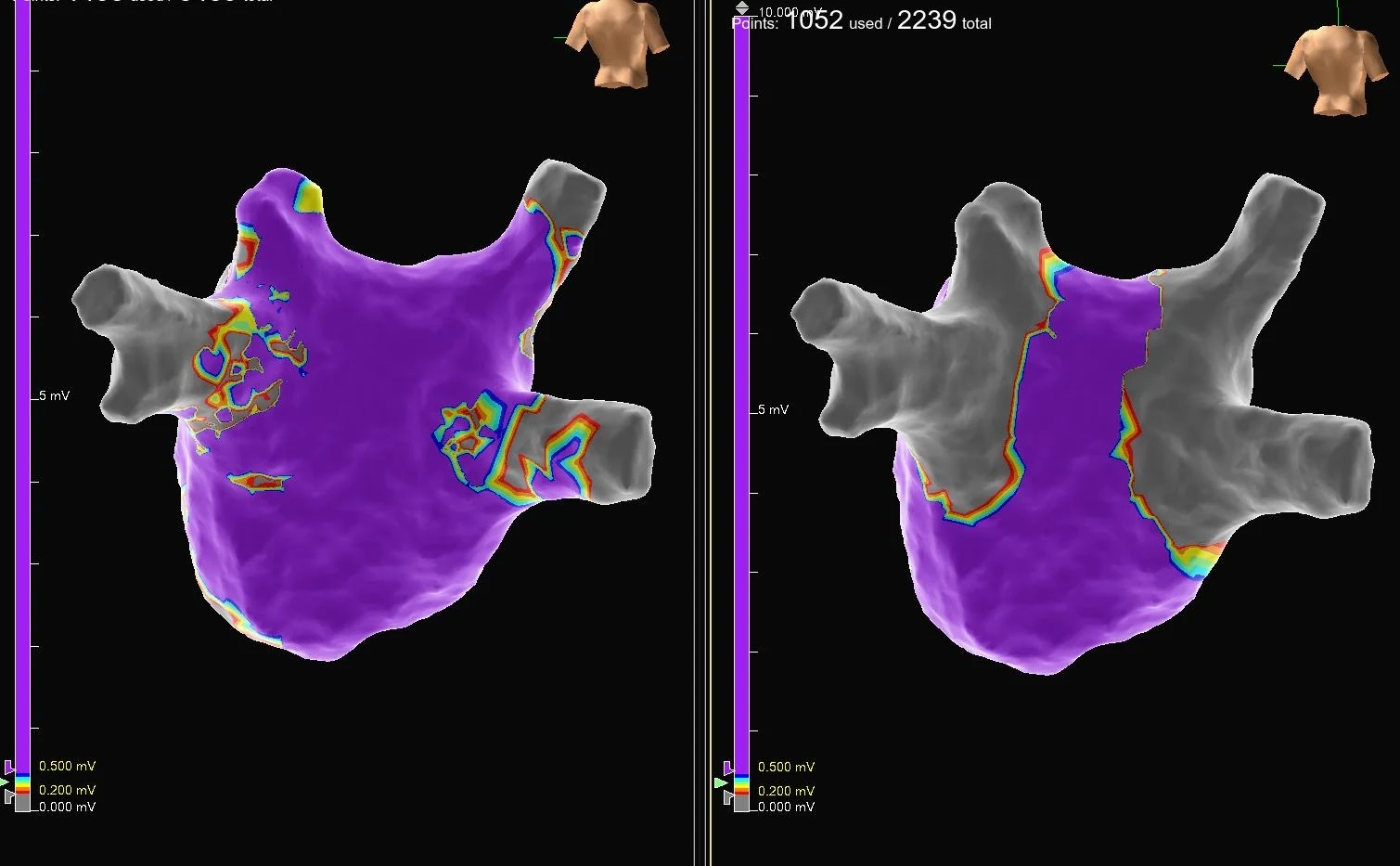 Pre and post pulmonary vein isolation in AF ablation