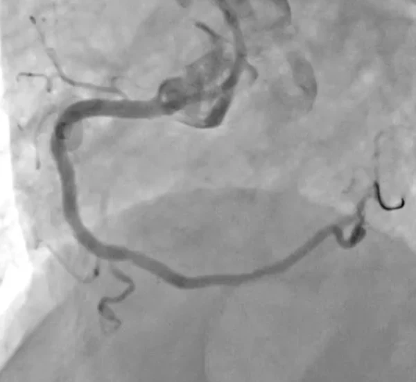 Coronary angiogram showing post angioplasty/stent