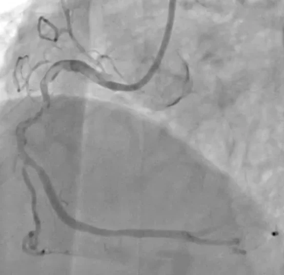 Coronary angiogram showing significant narrowing