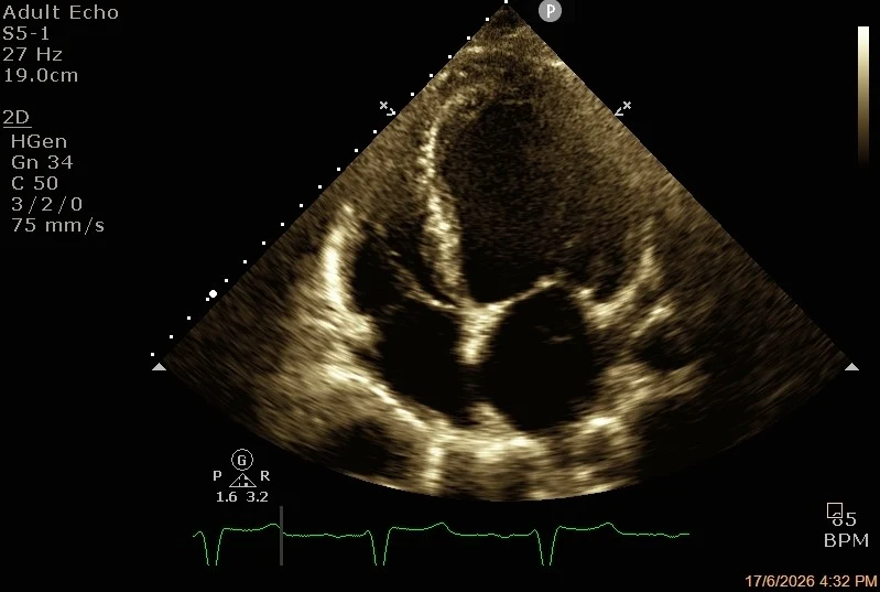 Echo image showing dilated heart with reduced function
