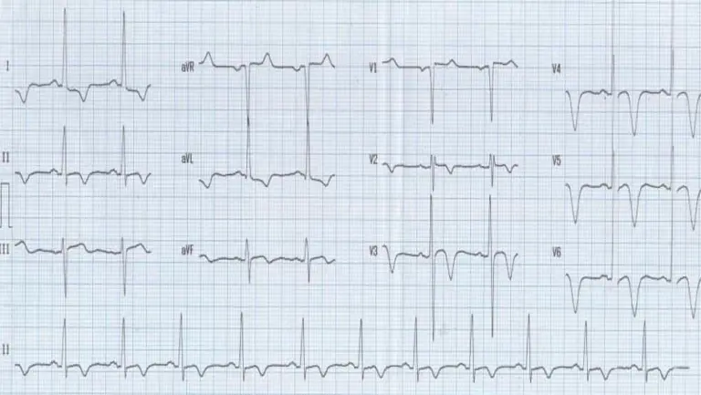 Hypertrophic Cardiomyopathy