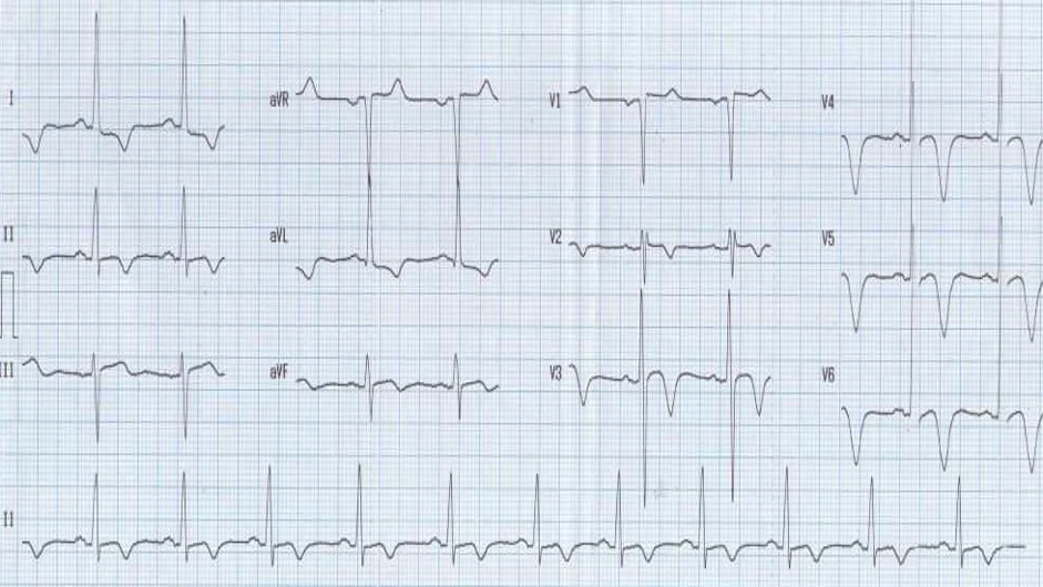 ECG showing apical HCM