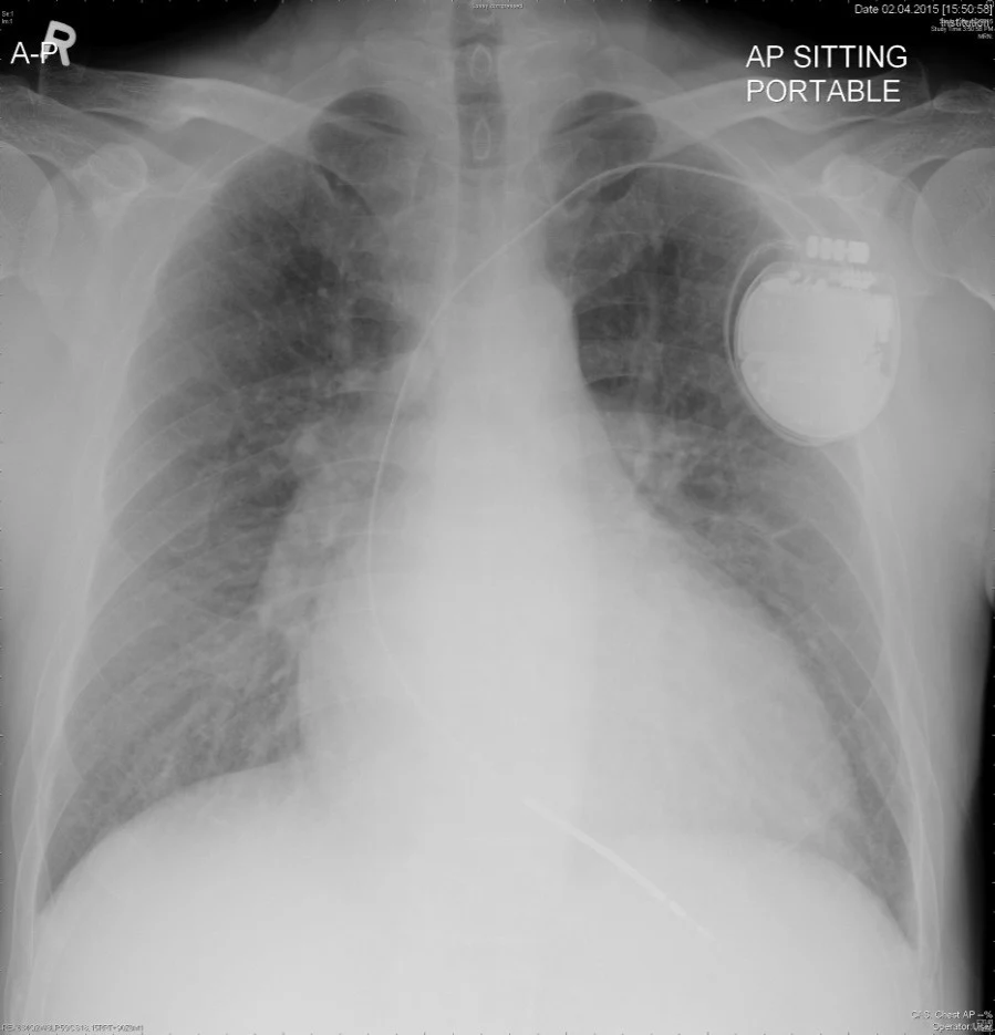 Transvenous ICD