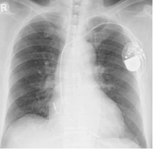 Pacemaker & Cardiac Device Implantation