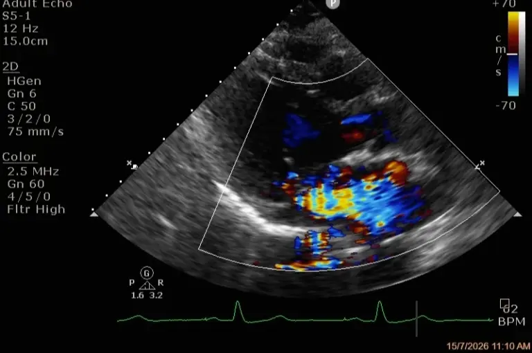 Valvular Heart Disease