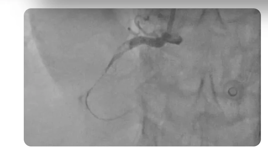 Coronary angiogram image